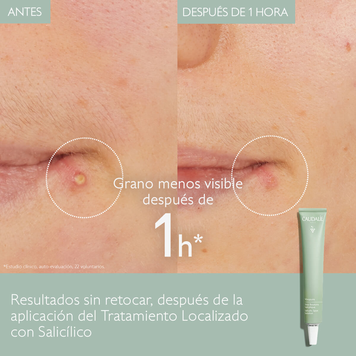 VINOPURE SOLUCIÓN LOCALIZADA CON ÁCIDO SALICÍLICO
